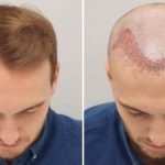 Hair Transplant