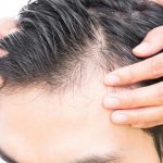 Male Hair Loss