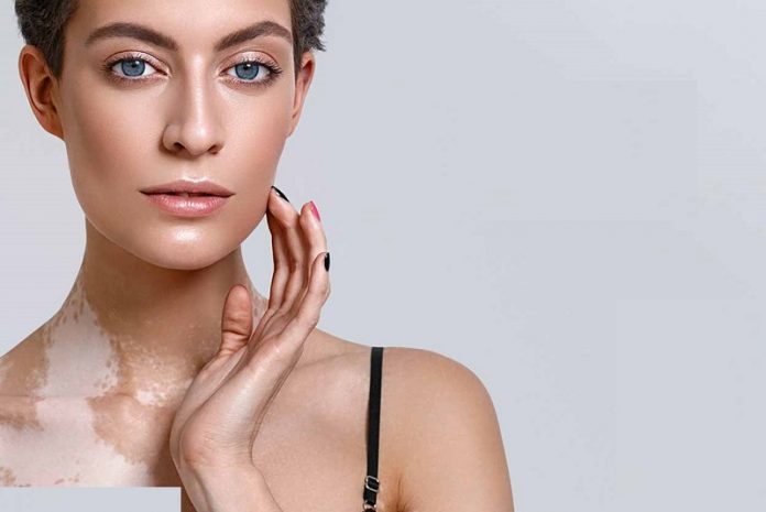 The Best Skin Care Products & How To Use Them For Vitiligo