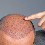 Hair Transplantation