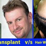 Hair Weaving Vs. Hair Transplant Which One Is Better