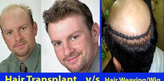 Hair Weaving Vs. Hair Transplant Which One Is Better