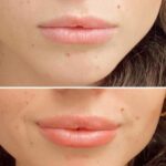 Lip Flip Before and After