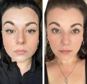 Before & After Masseter Botox