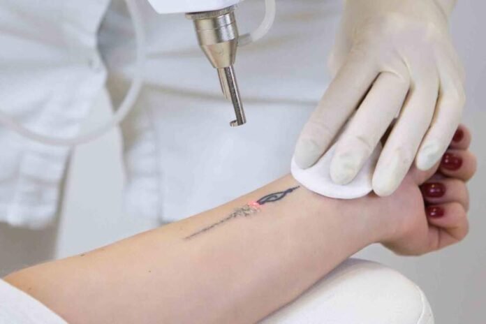 Tattoo Removal Near Me