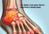 10 signs you may have morton's neuroma