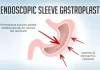 Endoscopic Sleeve Gastroplasty