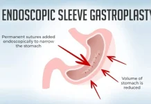 Endoscopic Sleeve Gastroplasty