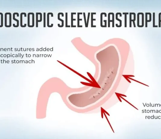 Endoscopic Sleeve Gastroplasty