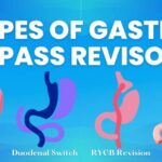 Gastric Bypass Revision