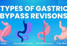 Gastric Bypass Revision