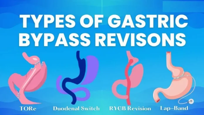 Gastric Bypass Revision